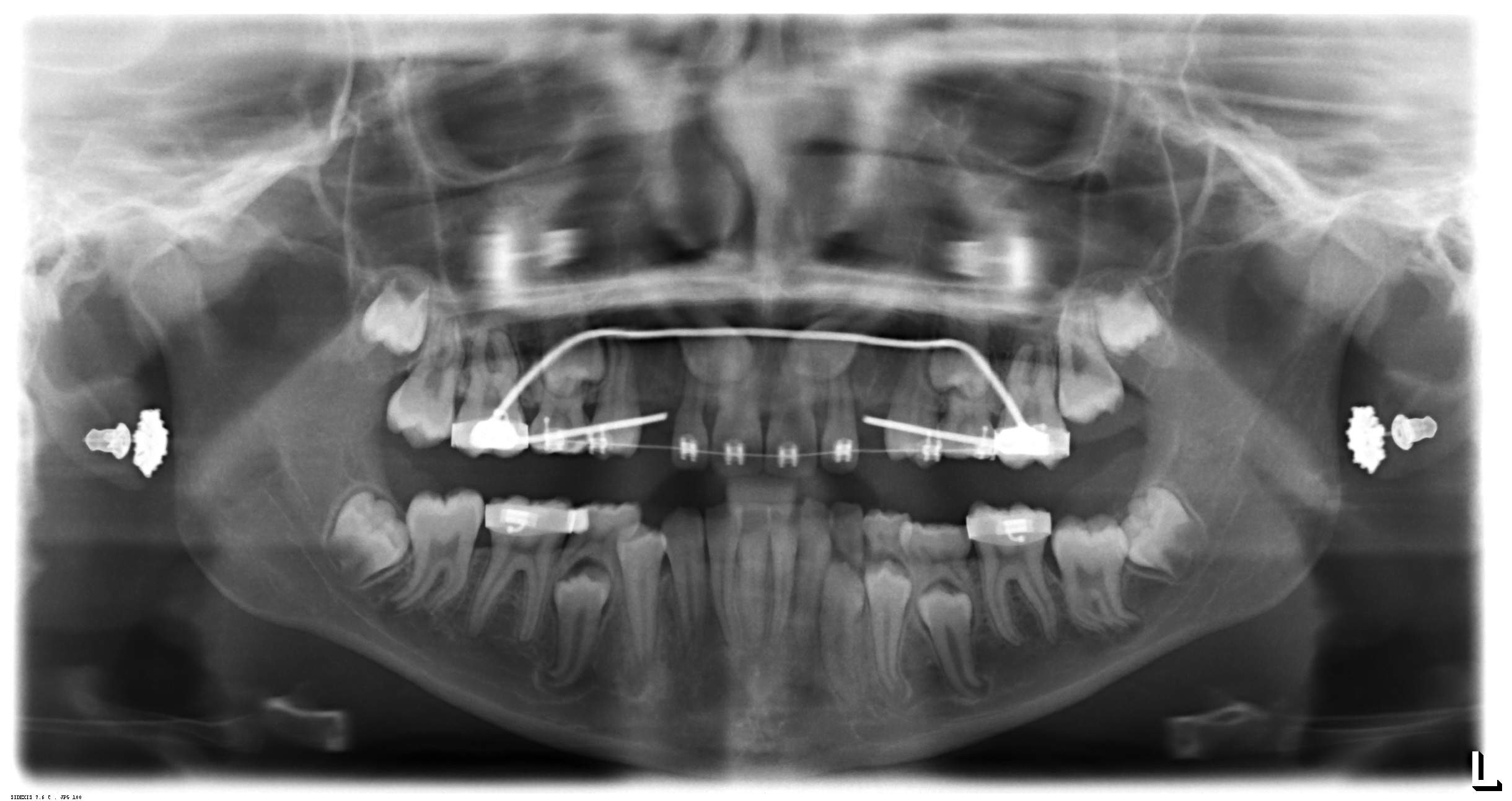 Impacted canine pre exposure canine
