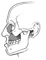 Orthognathic Surgery Illustration